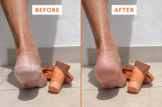 Cracked Heels & Sensitive Skin Set